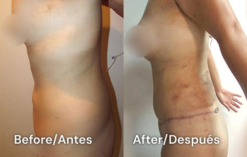 abdomen hd tijuana