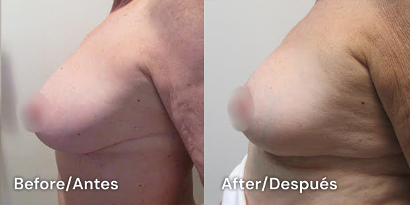 breast lift tijuana