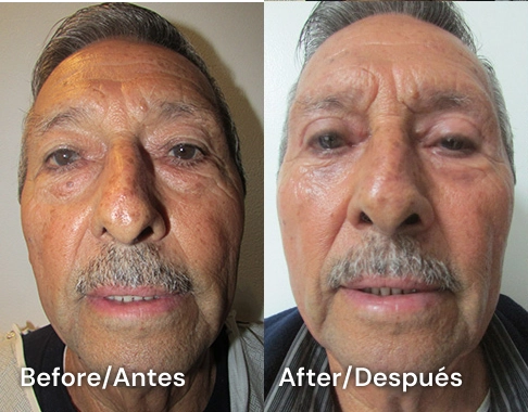 cirugia de parpados en tijuana