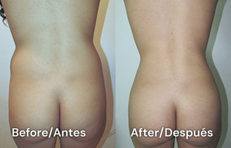 lipo en tijuana