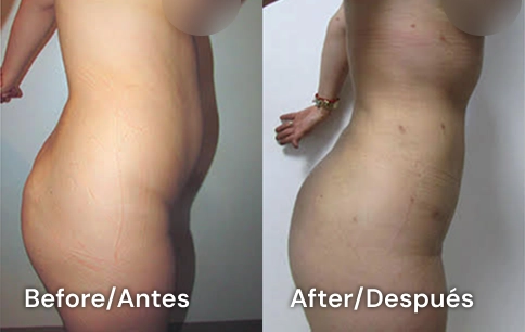 lipo san diego