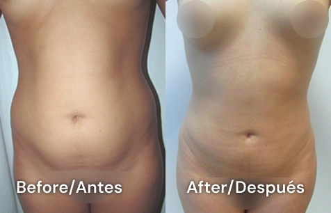 lipo testimonial 2