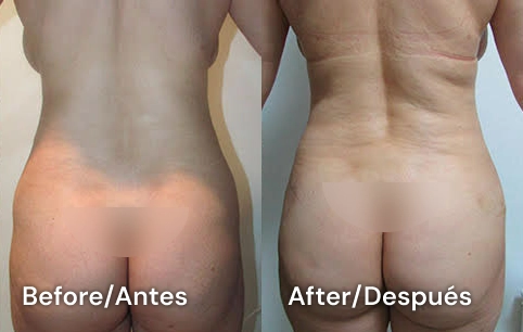 lipo testimonial