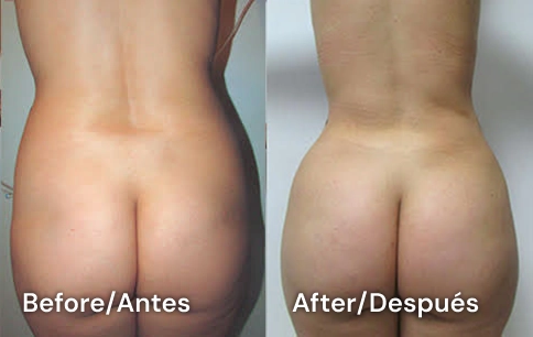 lipo tijuana