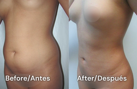 lipotestimonial 3