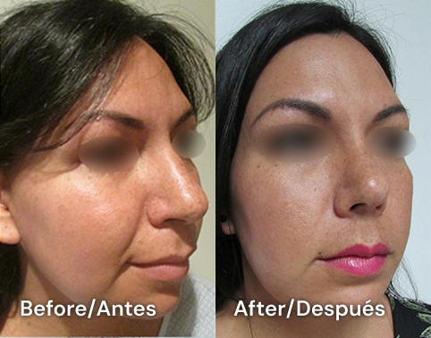 rinoplastia cirugia de nariz